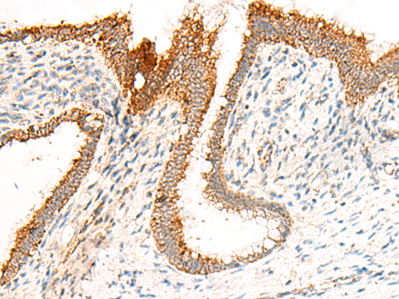 Immunohistochemistry of paraffin-embedded Human cervical cancer tissue  using GRIK5 Polyclonal Antibody at dilution of 1:35(×200)