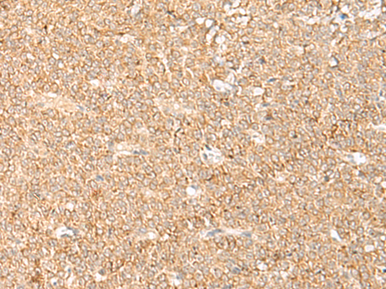 Immunohistochemistry of paraffin-embedded Human ovarian cancer tissue  using LGALSL Polyclonal Antibody at dilution of 1:70(×200)