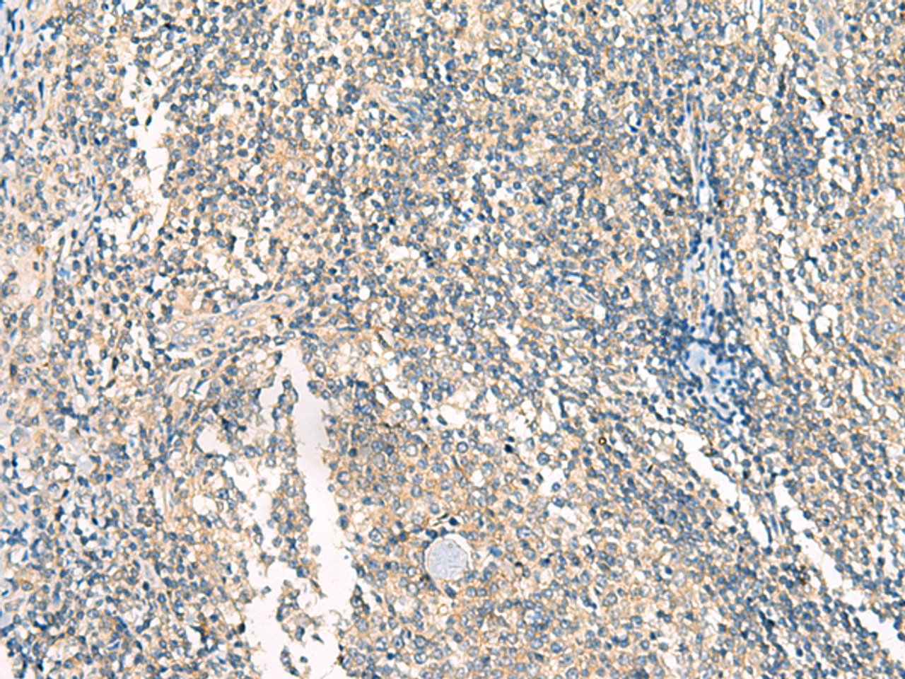 Immunohistochemistry of paraffin-embedded Human tonsil tissue  using HASPIN Polyclonal Antibody at dilution of 1:45(×200)