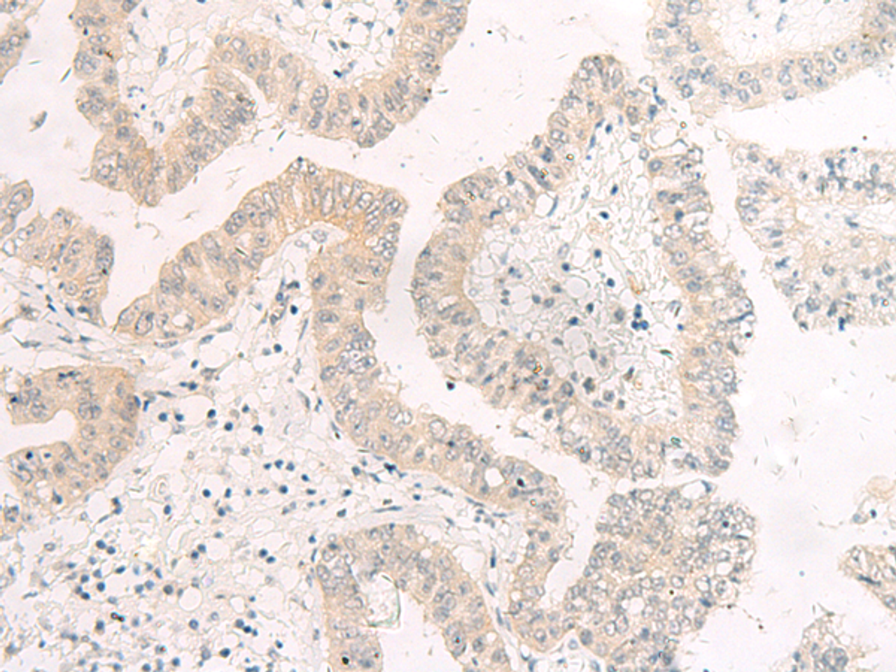 Immunohistochemistry of paraffin-embedded Human liver cancer tissue  using HASPIN Polyclonal Antibody at dilution of 1:45(×200)