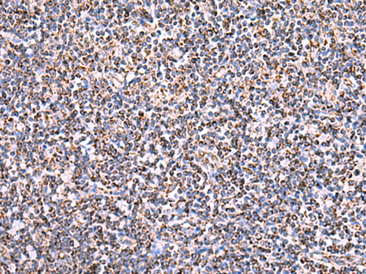 Immunohistochemistry of paraffin-embedded Human tonsil tissue  using HSF2BP Polyclonal Antibody at dilution of 1:30(×200)