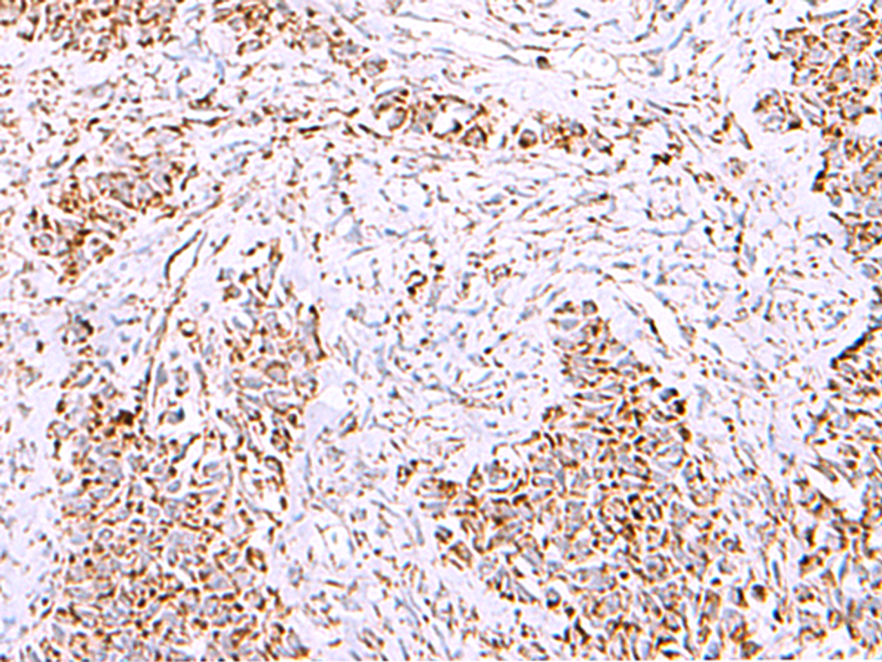 Immunohistochemistry of paraffin-embedded Human ovarian cancer tissue  using HSF2BP Polyclonal Antibody at dilution of 1:30(×200)