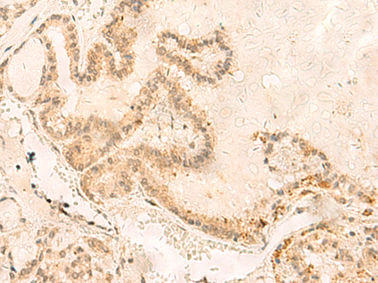 Immunohistochemistry of paraffin-embedded Human thyroid cancer tissue  using ZNF85 Polyclonal Antibody at dilution of 1:35(×200)