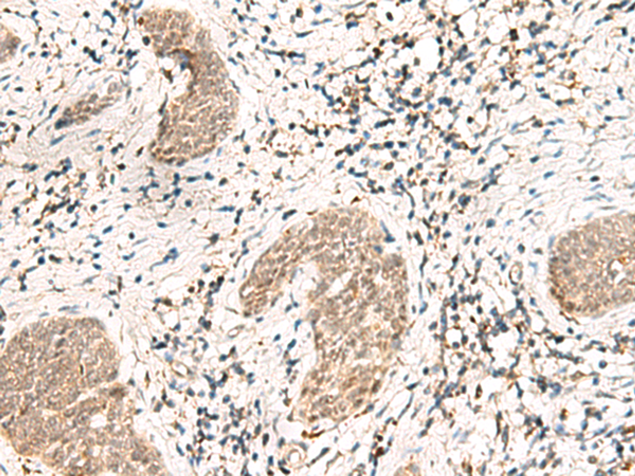 Immunohistochemistry of paraffin-embedded Human esophagus cancer tissue  using SNRPG Polyclonal Antibody at dilution of 1:40(×200)