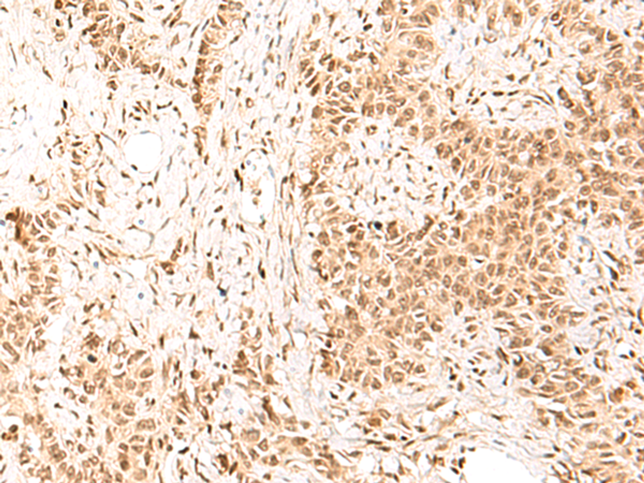 Immunohistochemistry of paraffin-embedded Human ovarian cancer tissue  using HIST1H1D Polyclonal Antibody at dilution of 1:55(×200)