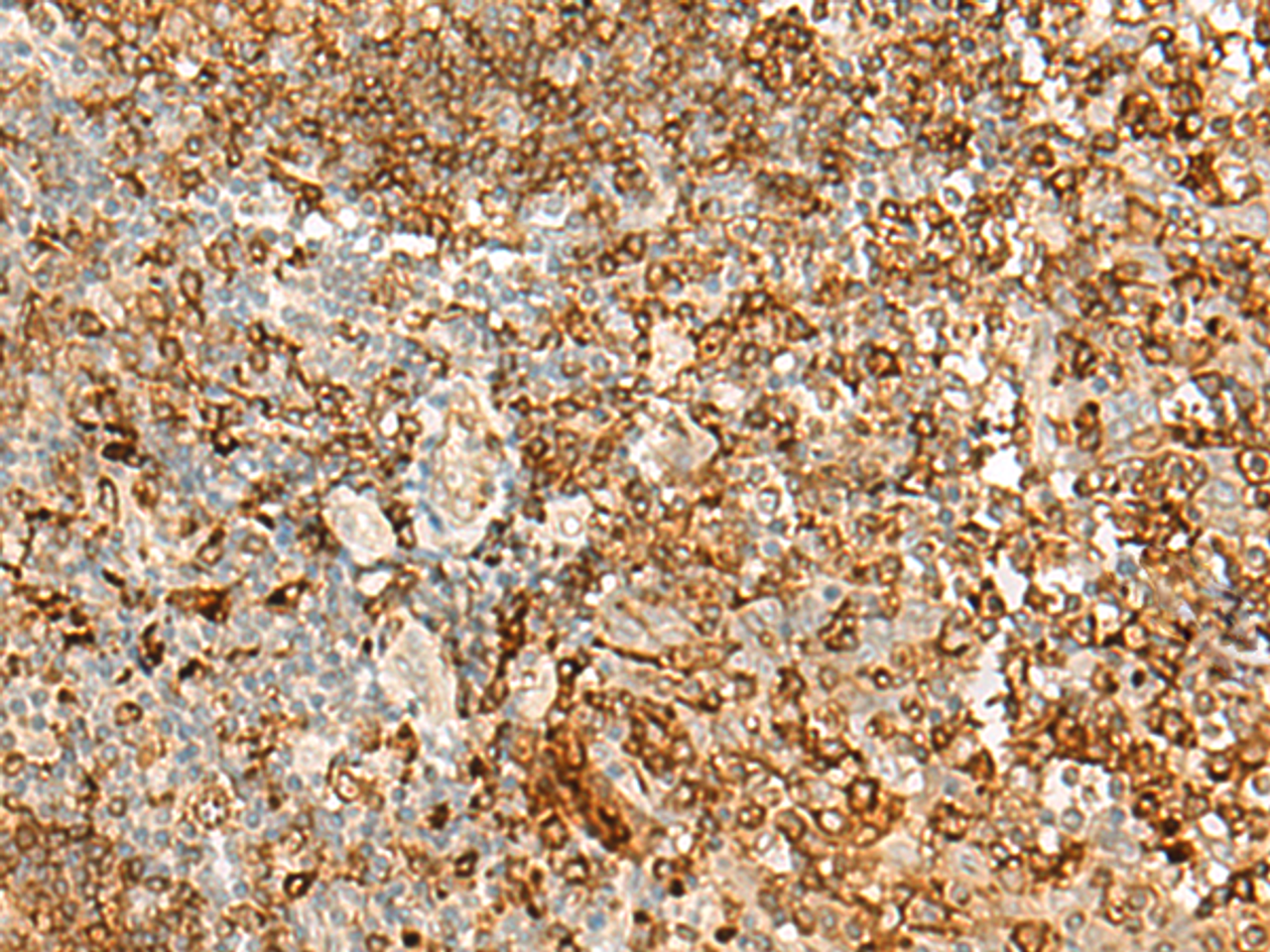 Immunohistochemistry of paraffin-embedded Human tonsil tissue  using HLA-DRB1 Polyclonal Antibody at dilution of 1:35(×200)