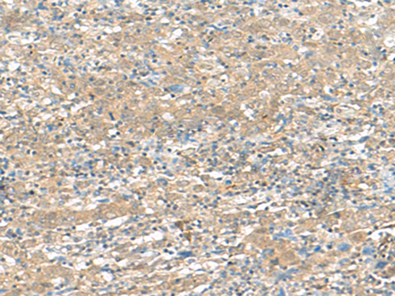Immunohistochemistry of paraffin-embedded Human cervical cancer tissue  using HMBOX1 Polyclonal Antibody at dilution of 1:30(×200)