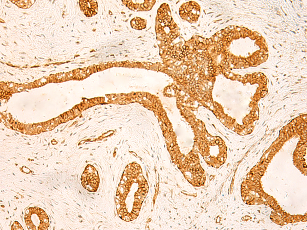 Immunohistochemistry of paraffin-embedded Human ovarian cancer tissue  using KRT76 Polyclonal Antibody at dilution of 1:50(×200)