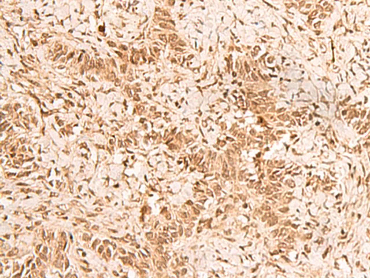 Immunohistochemistry of paraffin-embedded Human ovarian cancer tissue  using HOXC12 Polyclonal Antibody at dilution of 1:50(×200)