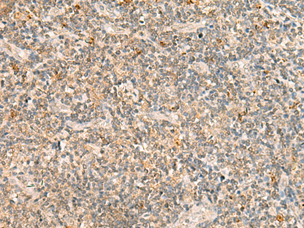Immunohistochemistry of paraffin-embedded Human tonsil tissue  using TBCK Polyclonal Antibody at dilution of 1:25(×200)