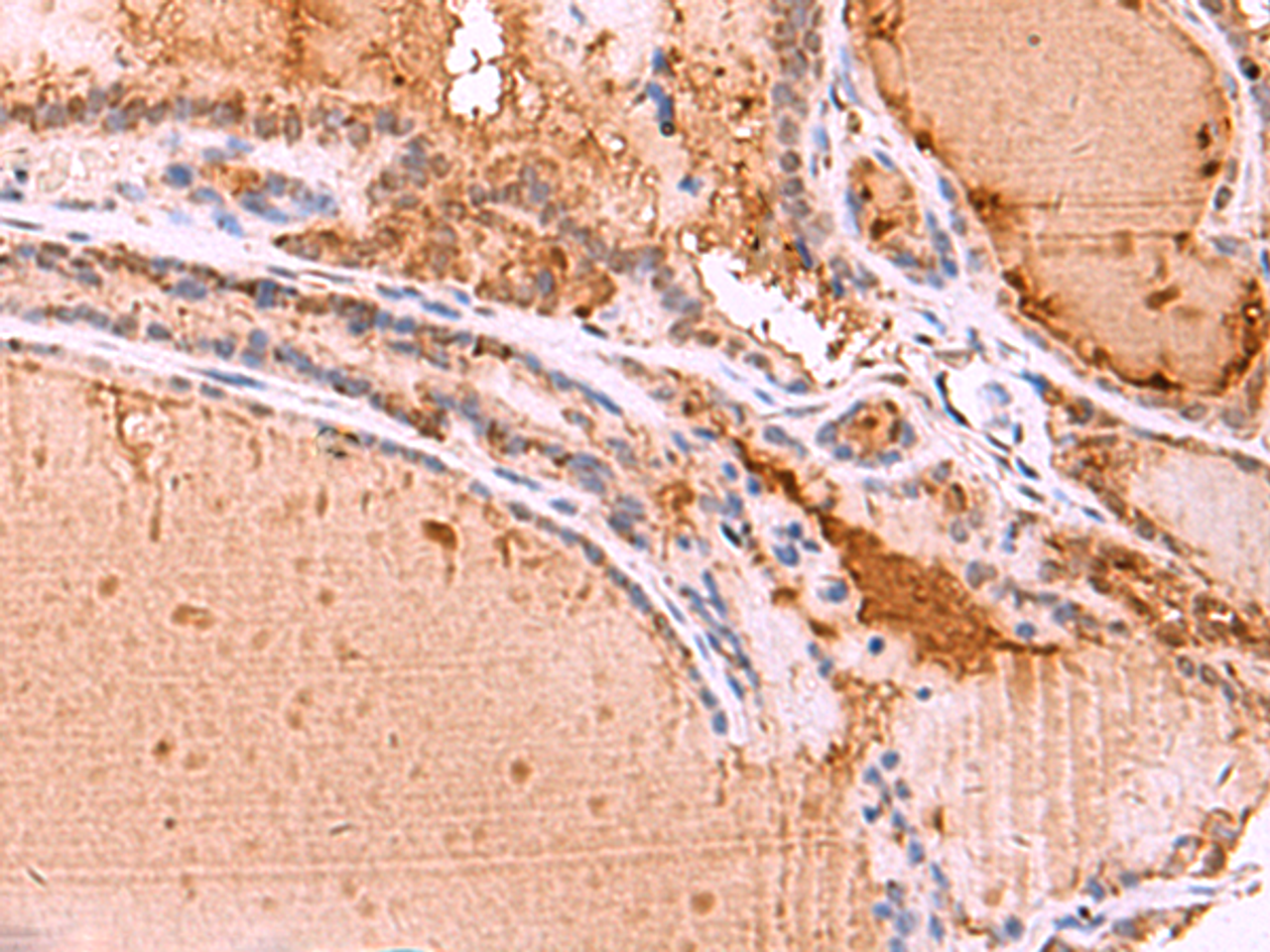 Immunohistochemistry of paraffin-embedded Human thyroid cancer tissue  using HTRA4 Polyclonal Antibody at dilution of 1:35(×200)