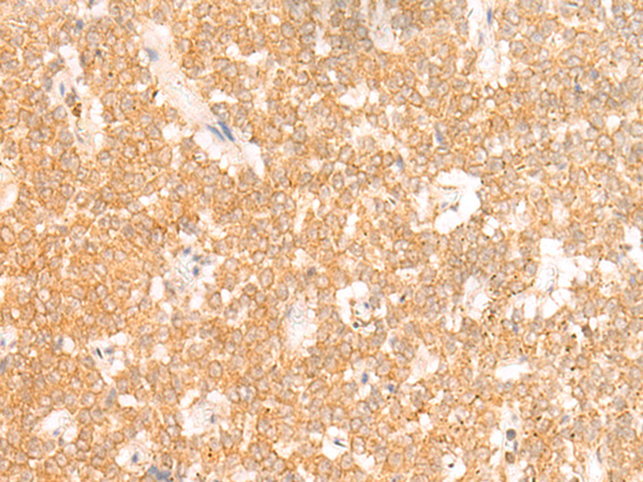 Immunohistochemistry of paraffin-embedded Human ovarian cancer tissue  using RRP8 Polyclonal Antibody at dilution of 1:50(×200)