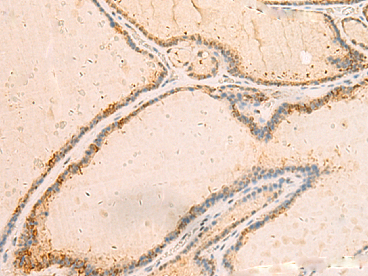 Immunohistochemistry of paraffin-embedded Human thyroid cancer tissue  using IP6K3 Polyclonal Antibody at dilution of 1:50(×200)