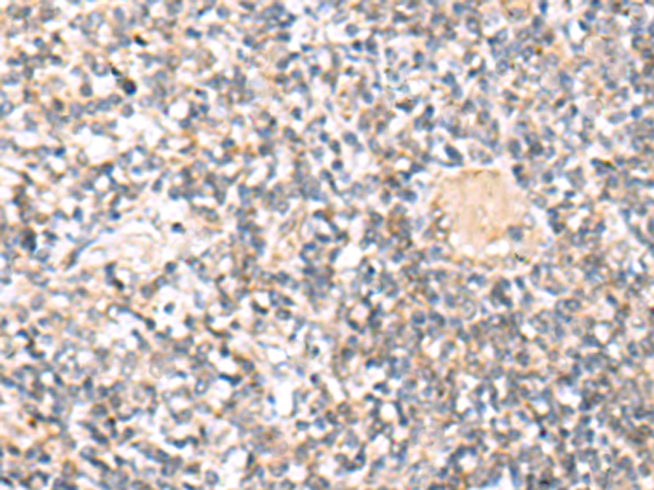 Immunohistochemistry of paraffin-embedded Human tonsil tissue  using IL36A Polyclonal Antibody at dilution of 1:30(×200)