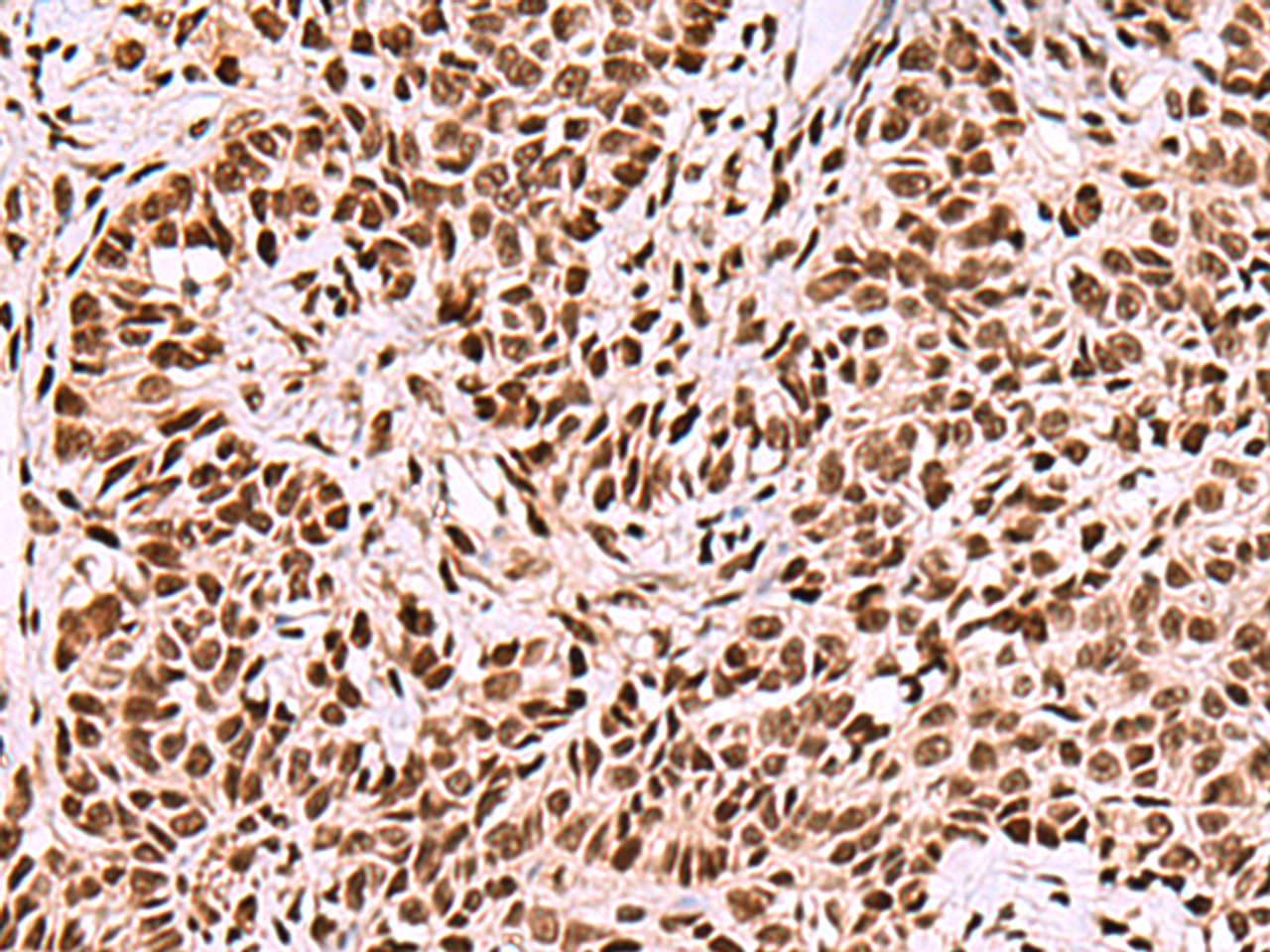 Immunohistochemistry of paraffin-embedded Human ovarian cancer tissue  using FOXK2 Polyclonal Antibody at dilution of 1:50(×200)