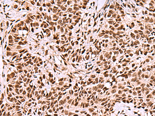 Immunohistochemistry of paraffin-embedded Human ovarian cancer tissue  using FOXK2 Polyclonal Antibody at dilution of 1:50(×200)