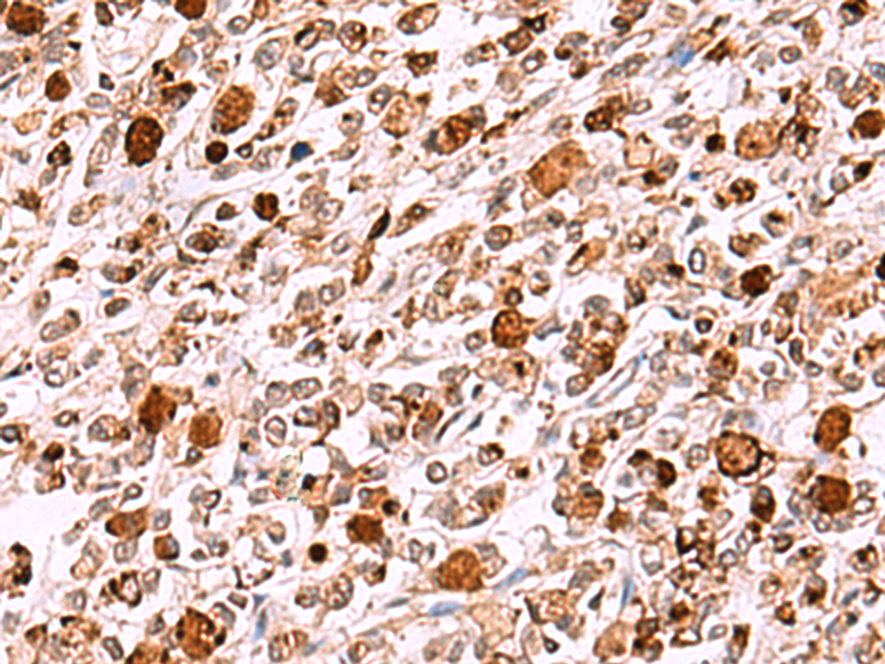 Immunohistochemistry of paraffin-embedded Human gastric cancer tissue  using INO80 Polyclonal Antibody at dilution of 1:85(×200)