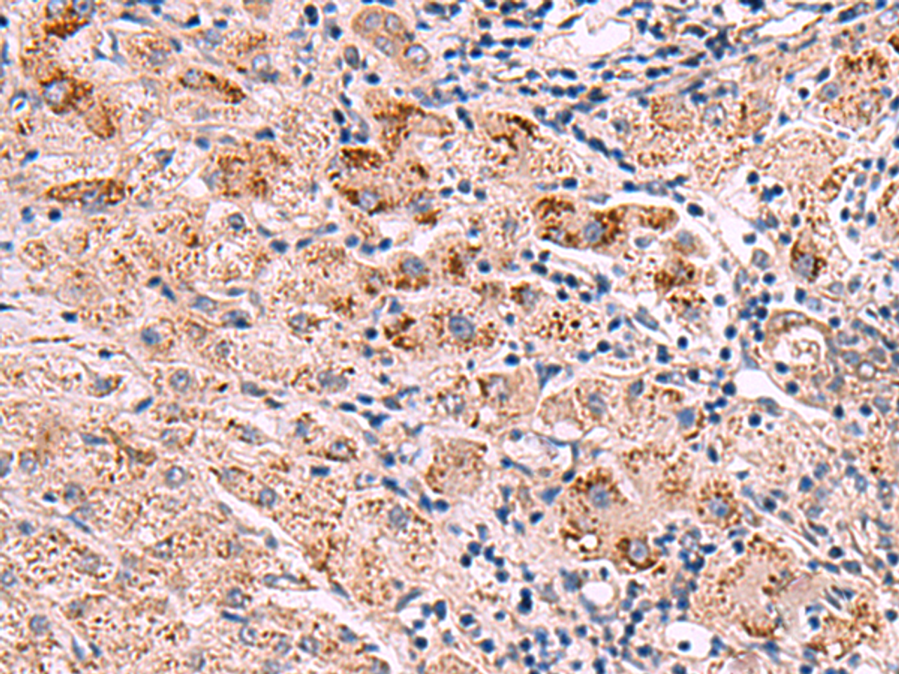Immunohistochemistry of paraffin-embedded Human liver cancer tissue  using INPP5B Polyclonal Antibody at dilution of 1:40(×200)