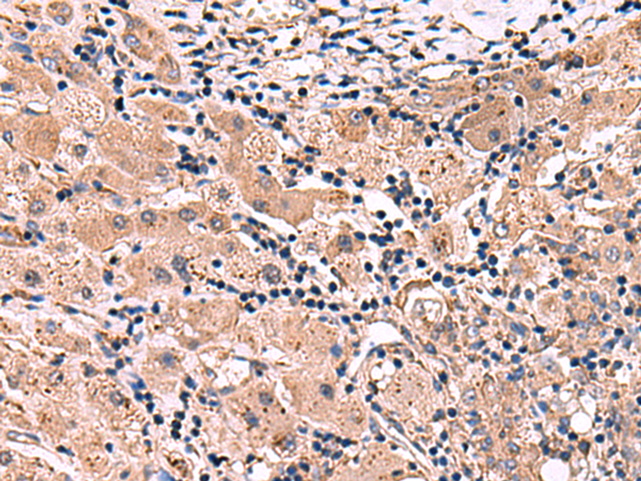 Immunohistochemistry of paraffin-embedded Human liver cancer tissue  using INSC Polyclonal Antibody at dilution of 1:65(×200)