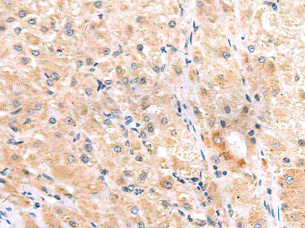 Immunohistochemistry of paraffin-embedded Human liver cancer tissue  using ITGA3 Polyclonal Antibody at dilution of 1:45(×200)