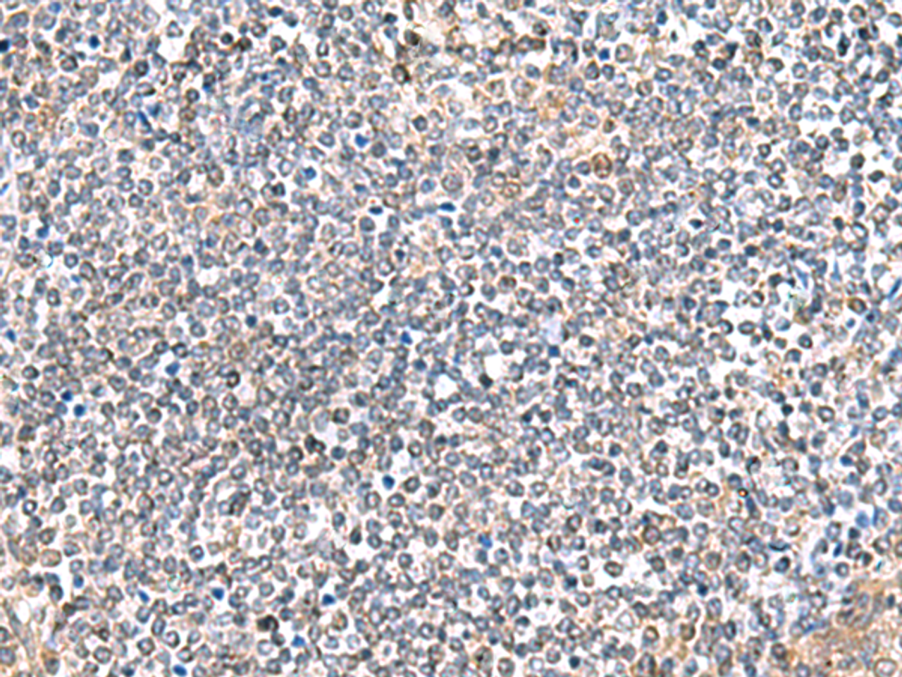 Immunohistochemistry of paraffin-embedded Human tonsil tissue  using ITGA3 Polyclonal Antibody at dilution of 1:45(×200)
