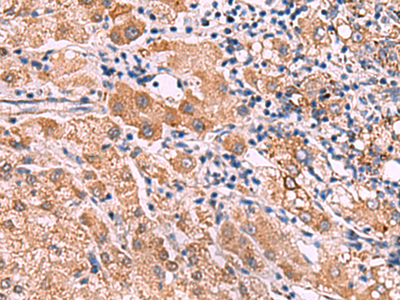 Immunohistochemistry of paraffin-embedded Human liver cancer tissue  using IPPK Polyclonal Antibody at dilution of 1:30(×200)