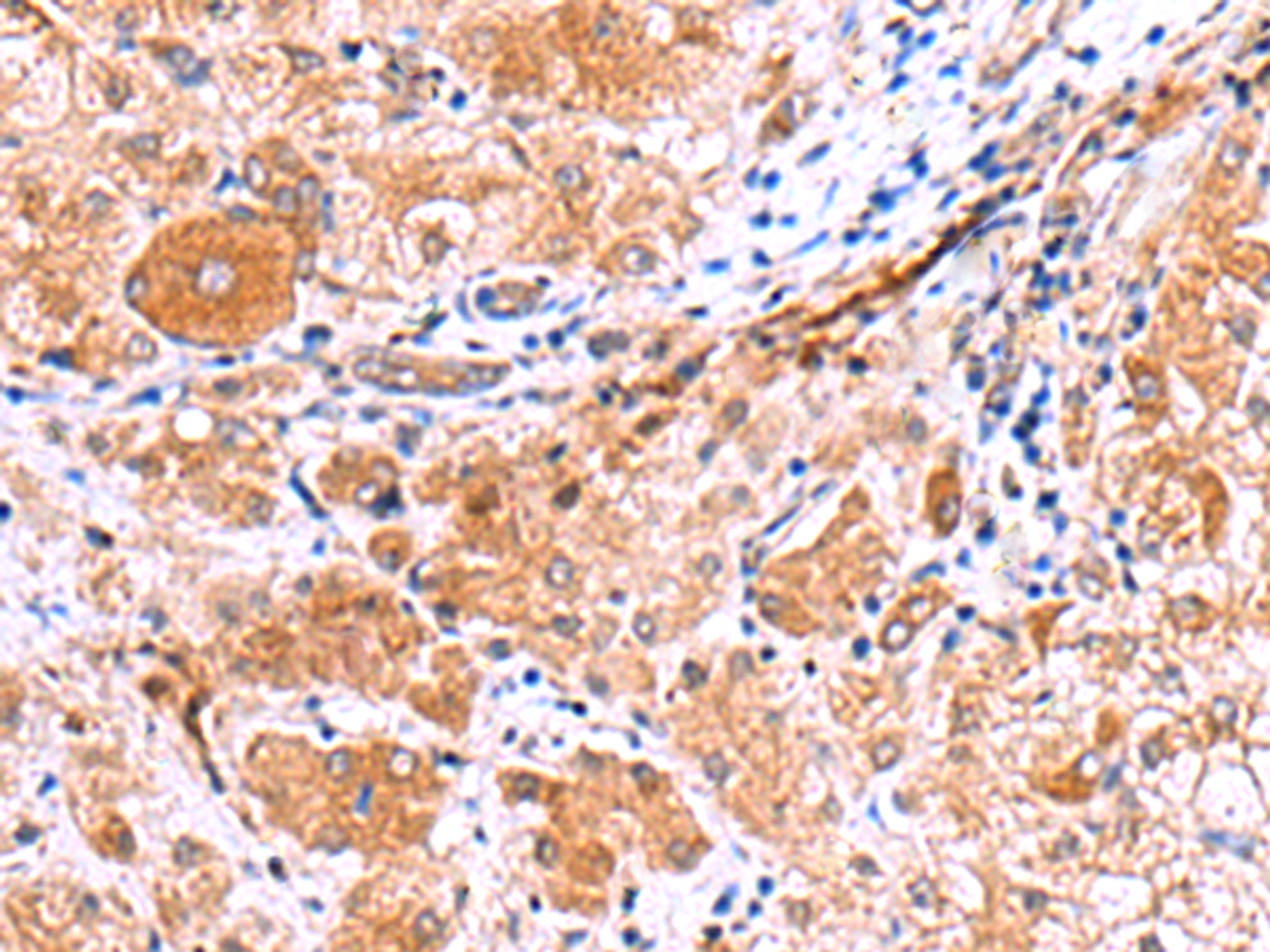 Immunohistochemistry of paraffin-embedded Human liver cancer tissue  using IRGC Polyclonal Antibody at dilution of 1:30(×200)