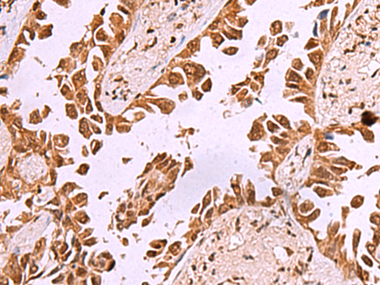 Immunohistochemistry of paraffin-embedded Human lung cancer tissue  using IRX1 Polyclonal Antibody at dilution of 1:35(×200)