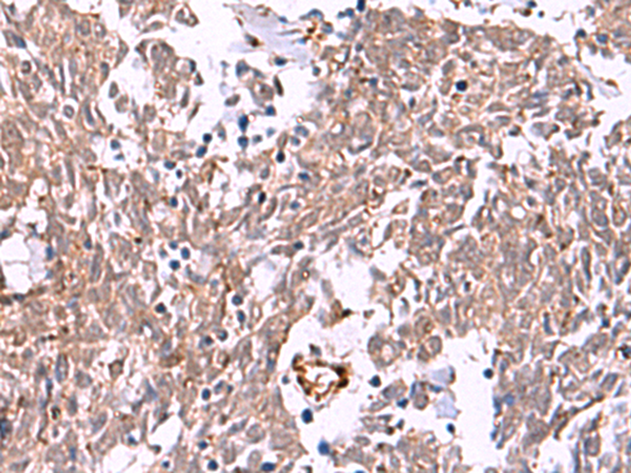Immunohistochemistry of paraffin-embedded Human lung cancer tissue  using IRX2 Polyclonal Antibody at dilution of 1:45(×200)