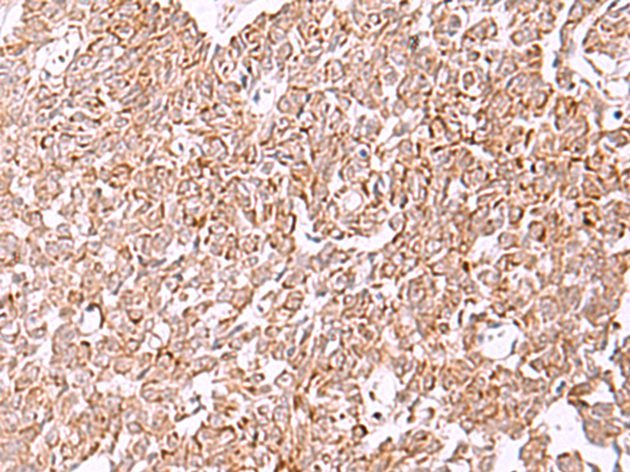 Immunohistochemistry of paraffin-embedded Human ovarian cancer tissue  using IRX2 Polyclonal Antibody at dilution of 1:45(×200)