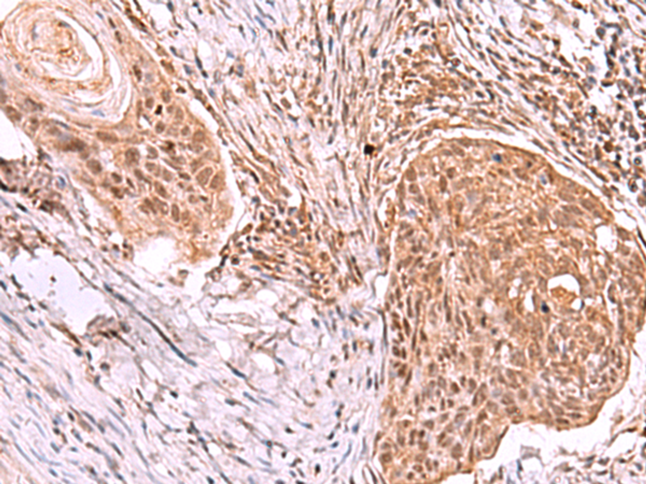Immunohistochemistry of paraffin-embedded Human esophagus cancer tissue  using IRX4 Polyclonal Antibody at dilution of 1:40(×200)