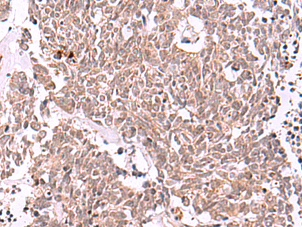 Immunohistochemistry of paraffin-embedded Human lung cancer tissue  using IRX4 Polyclonal Antibody at dilution of 1:40(×200)