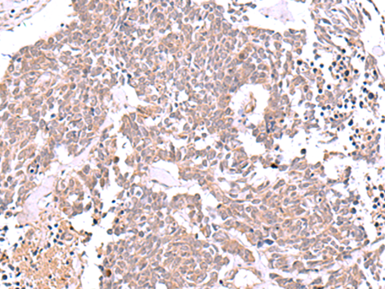 Immunohistochemistry of paraffin-embedded Human lung cancer tissue  using JDP2 Polyclonal Antibody at dilution of 1:40(×200)