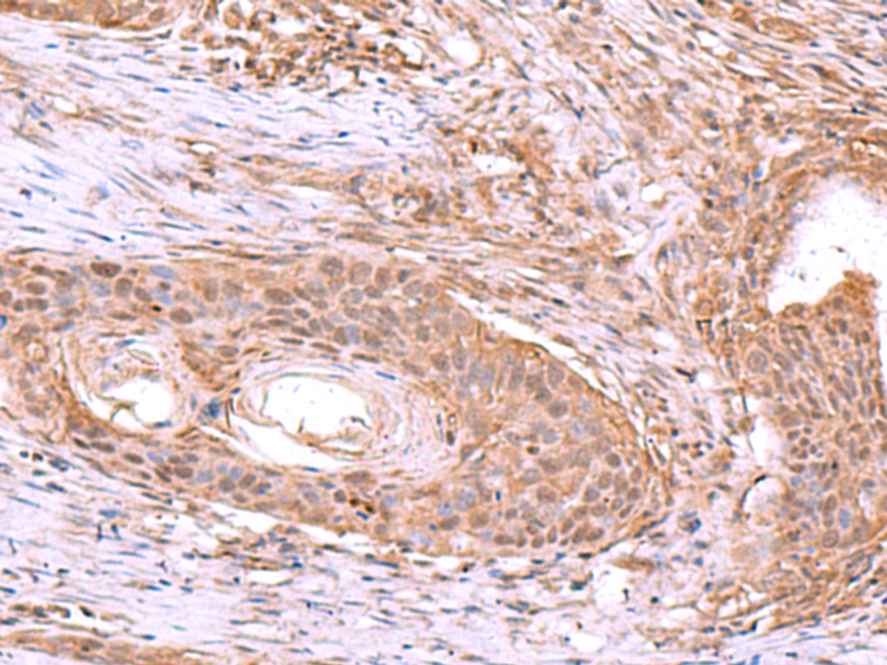 Immunohistochemistry of paraffin-embedded Human esophagus cancer tissue  using JDP2 Polyclonal Antibody at dilution of 1:40(×200)
