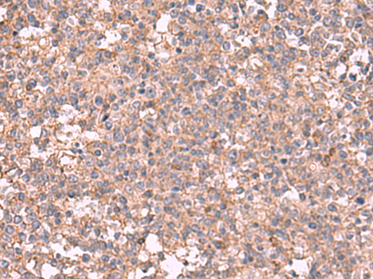 Immunohistochemistry of paraffin-embedded Human tonsil tissue  using MAPK8IP3 Polyclonal Antibody at dilution of 1:45(×200)