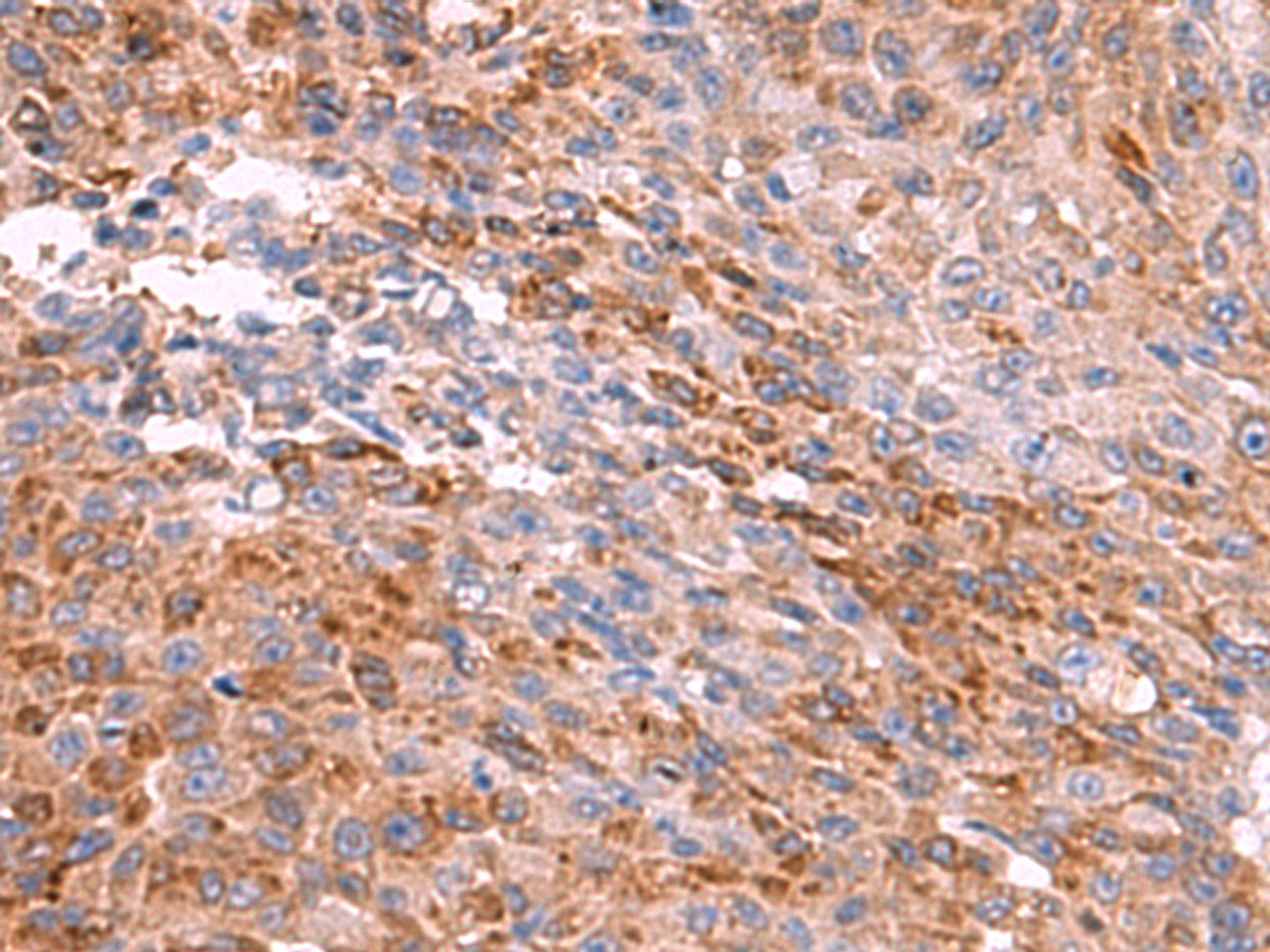 Immunohistochemistry of paraffin-embedded Human colorectal cancer tissue  using PEMT Polyclonal Antibody at dilution of 1:55(×200)