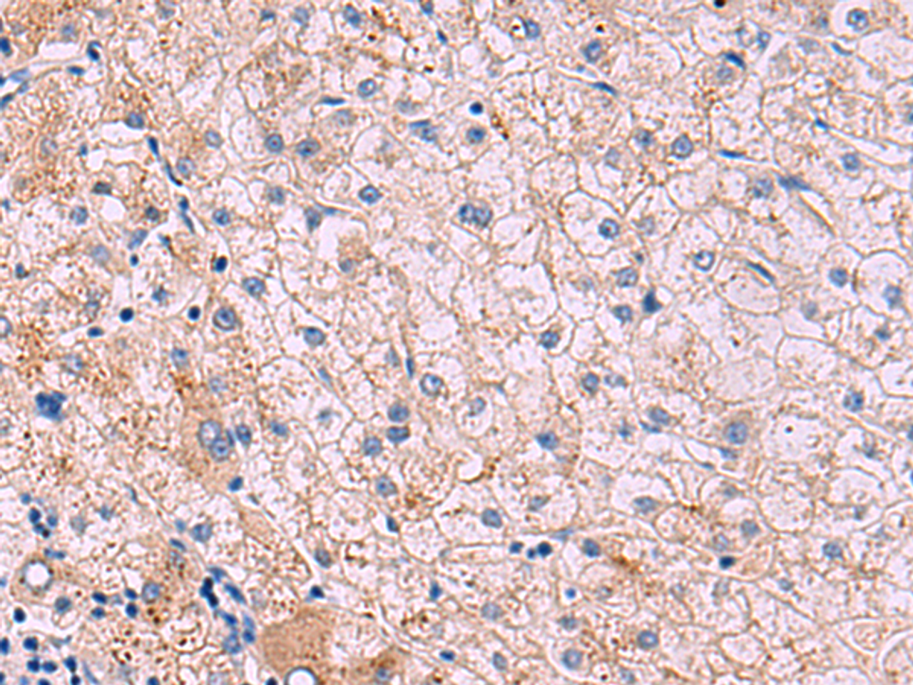 Immunohistochemistry of paraffin-embedded Human liver cancer tissue  using JAM3 Polyclonal Antibody at dilution of 1:40(×200)