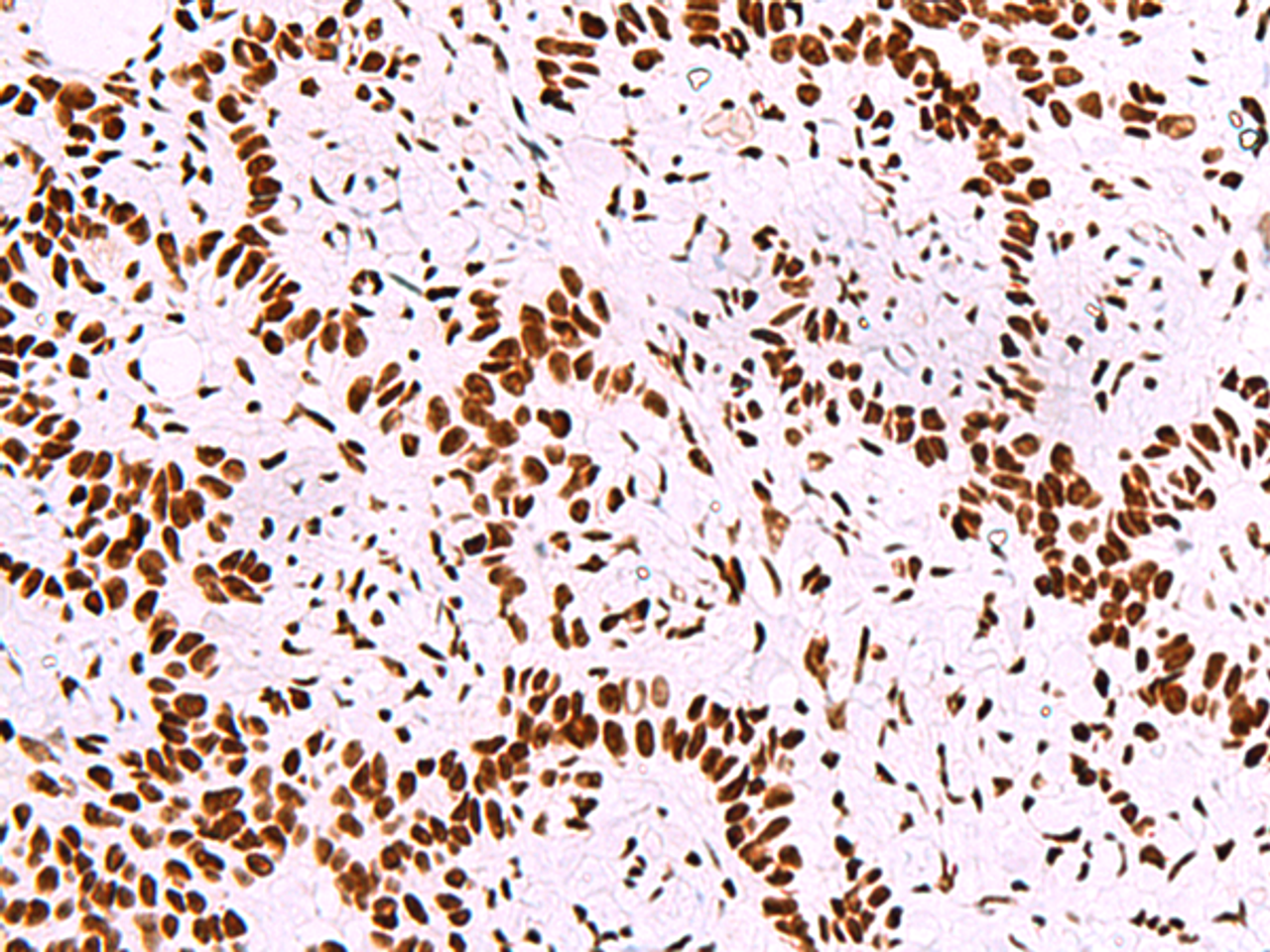 Immunohistochemistry of paraffin-embedded Human ovarian cancer tissue  using TRIM28(phospho-Ser824) Polyclonal Antibody at dilution of 1:50(×200)