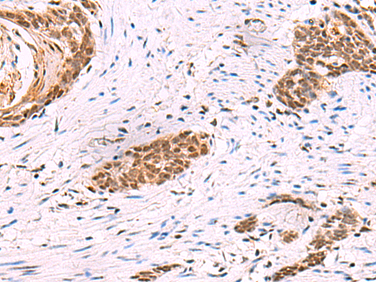 Immunohistochemistry of paraffin-embedded Human esophagus cancer tissue  using CREBBP Polyclonal Antibody at dilution of 1:35(×200)