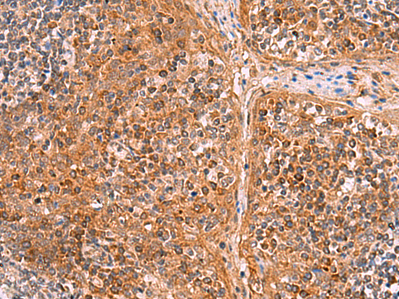 Immunohistochemistry of paraffin-embedded Human tonsil tissue  using CREBBP Polyclonal Antibody at dilution of 1:35(×200)