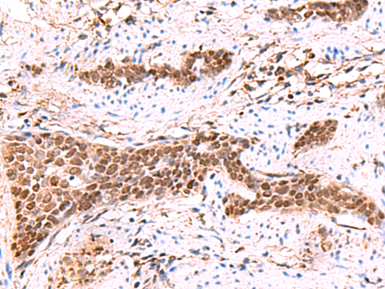 Immunohistochemistry of paraffin-embedded Human esophagus cancer tissue  using SOX2 Polyclonal Antibody at dilution of 1:35(×200)