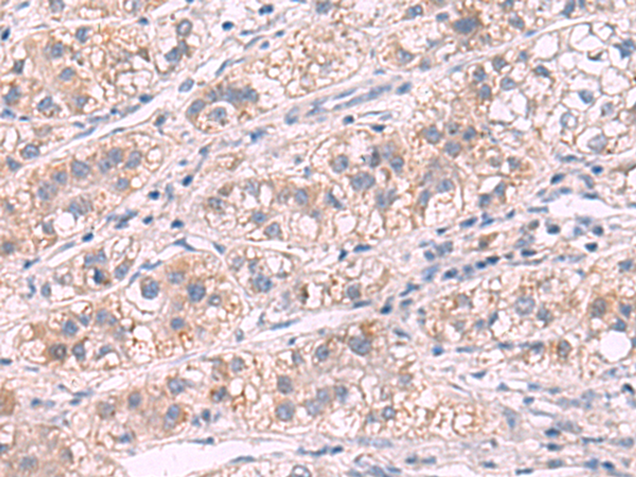 Immunohistochemistry of paraffin-embedded Human liver cancer tissue  using G6PC Polyclonal Antibody at dilution of 1:50(×200)