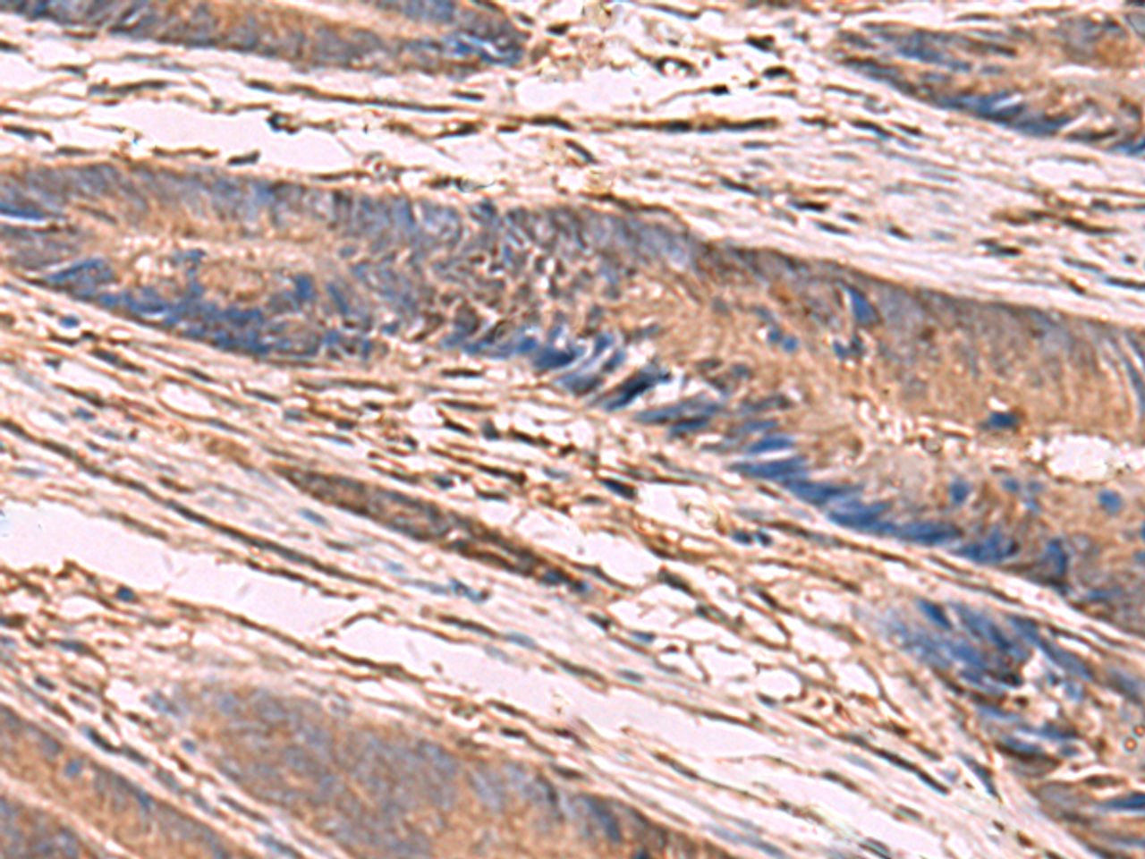 Immunohistochemistry of paraffin-embedded Human colorectal cancer tissue  using KCNN2 Polyclonal Antibody at dilution of 1:65(×200)