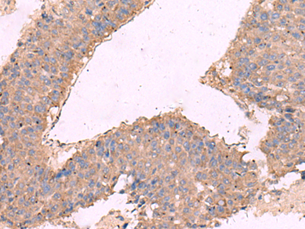 Immunohistochemistry of paraffin-embedded Human liver cancer tissue  using KCNN3 Polyclonal Antibody at dilution of 1:40(×200)