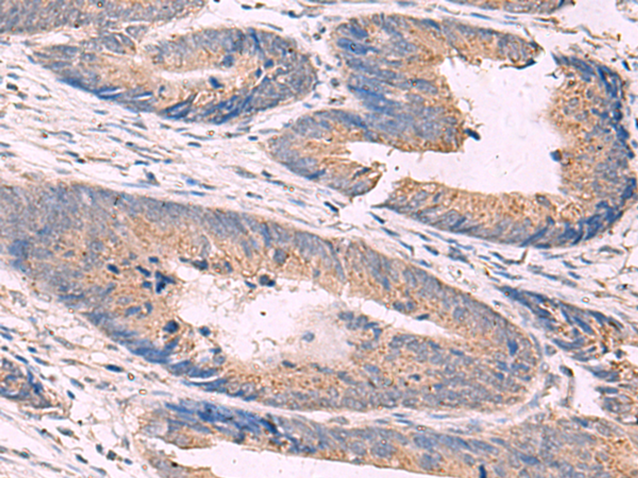Immunohistochemistry of paraffin-embedded Human colorectal cancer tissue  using KCNN3 Polyclonal Antibody at dilution of 1:40(×200)