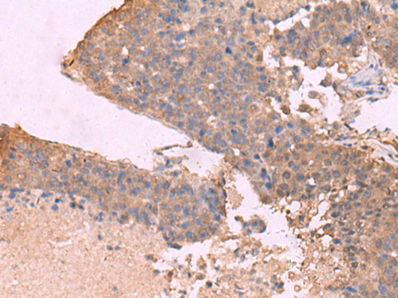 Immunohistochemistry of paraffin-embedded Human liver cancer tissue  using KCNU1 Polyclonal Antibody at dilution of 1:45(×200)