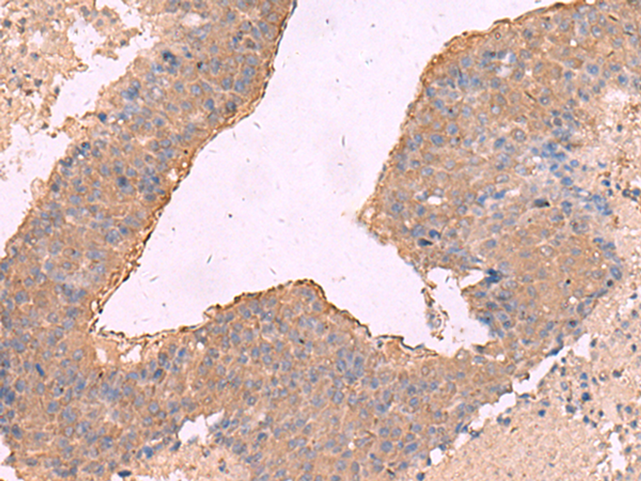 Immunohistochemistry of paraffin-embedded Human liver cancer tissue  using NIPSNAP1 Polyclonal Antibody at dilution of 1:50(×200)
