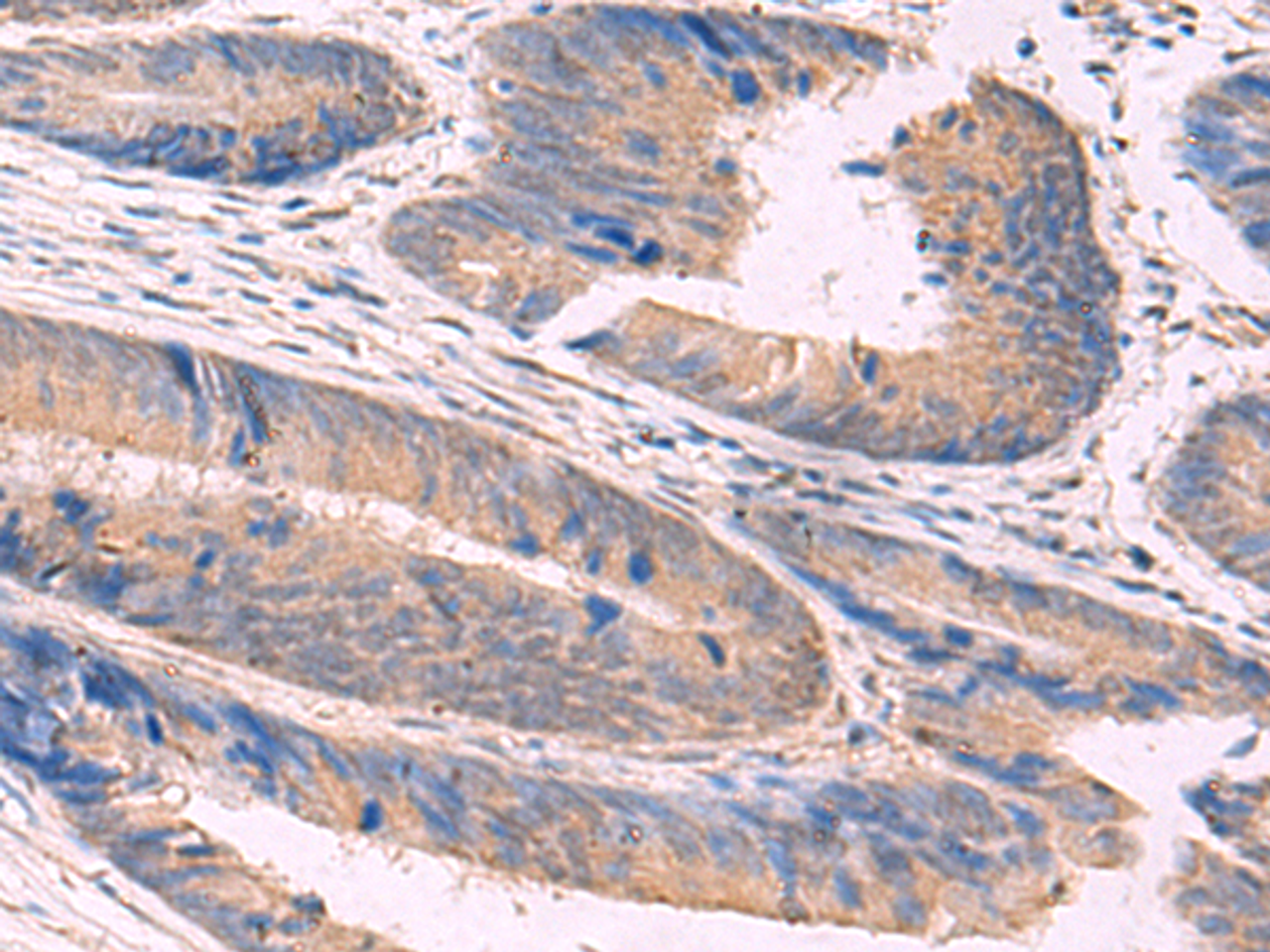 Immunohistochemistry of paraffin-embedded Human colorectal cancer tissue  using NIPSNAP1 Polyclonal Antibody at dilution of 1:50(×200)