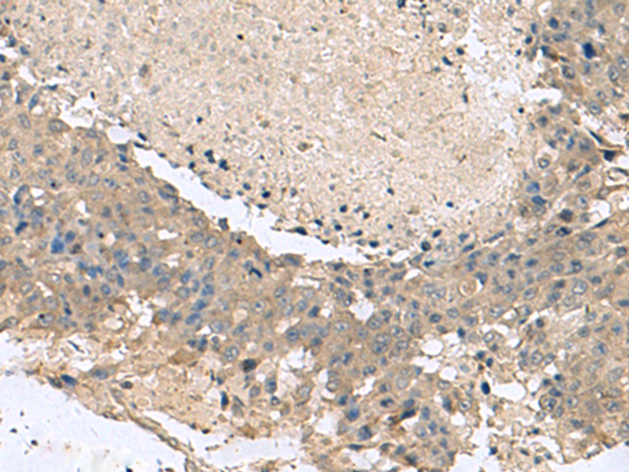 Immunohistochemistry of paraffin-embedded Human liver cancer tissue  using KCTD7 Polyclonal Antibody at dilution of 1:55(×200)