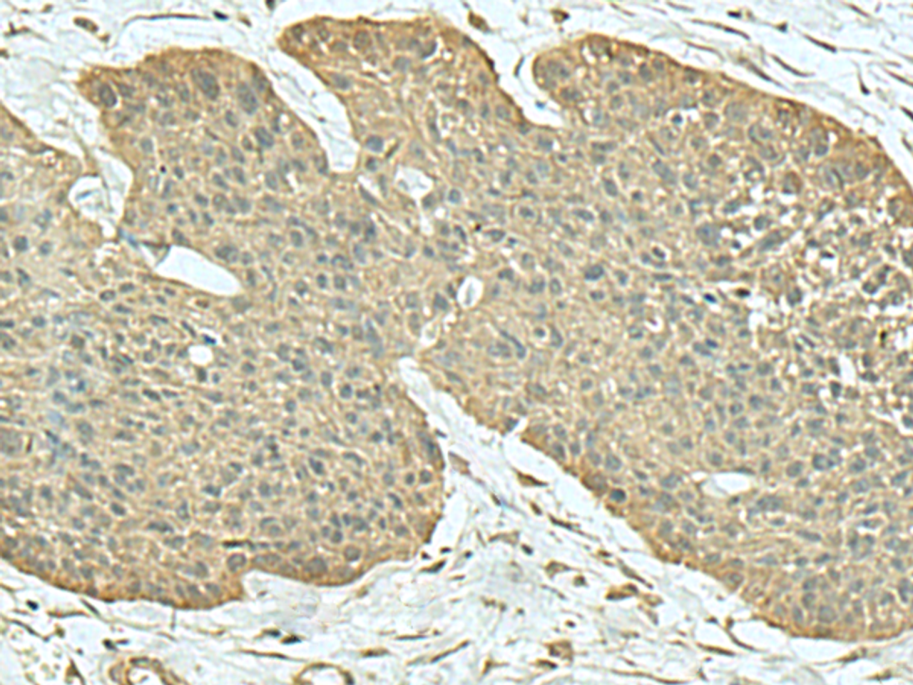 Immunohistochemistry of paraffin-embedded Human esophagus cancer tissue  using FN3KRP Polyclonal Antibody at dilution of 1:55(×200)